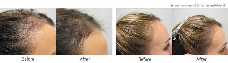 Viviscal Professional Before And After
