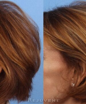 Viviscal Before and After fuller hair