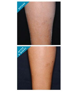 Before and After using Body Retexturizing treatment