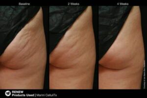 Before and after image of CelluliTx use