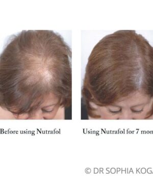 Nutrafol before after female patient