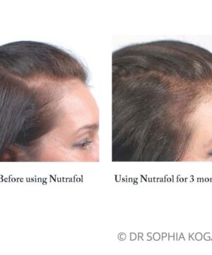 Nutrafol patient before after female