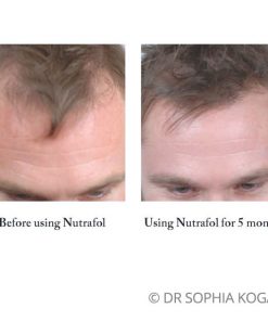 Nutrafol before after Male patient