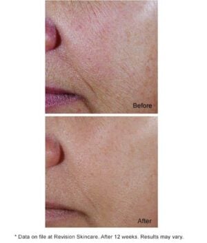 Before and After C Plus Correcting Complex