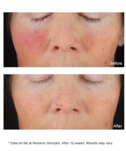 Before and After C Plus Correcting Complex