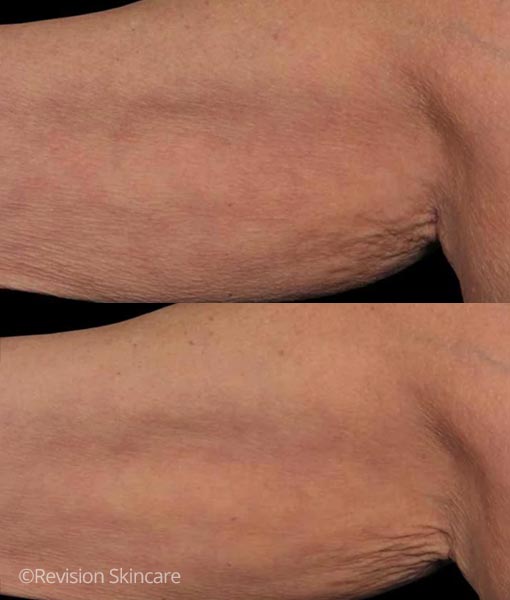 Arm image before and after treatment