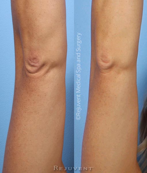 Closeup of elbow improvement after Bodifirm lotion