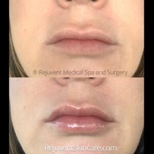 Before and after results of YouthFull Lip Replenisher