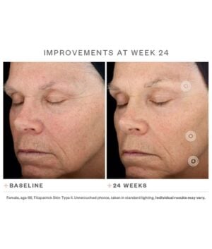 Week 24 before and after TNS Advanced+ Serum