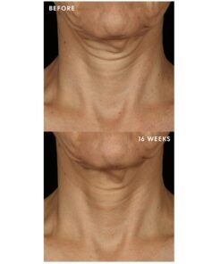 Tripeptide-R Neck Repair before and after photo