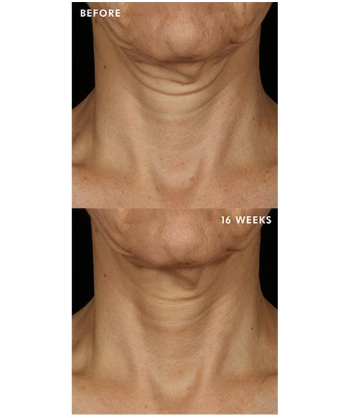 Tripeptide-R Neck Repair before and after photo