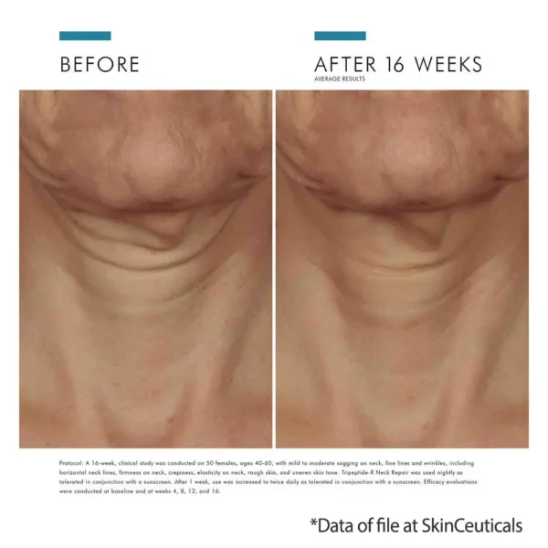 Skinceuticals Tripeptide-R Neck Repair amazing results show fewer wrinkles