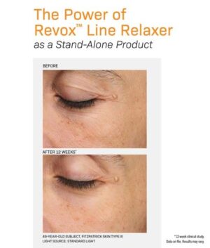 Revox Line Relaxer before and after image