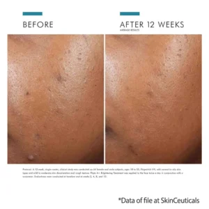 Skinceuticals Phyto A+ brightening treatment before and after results shows faded acne dark spots