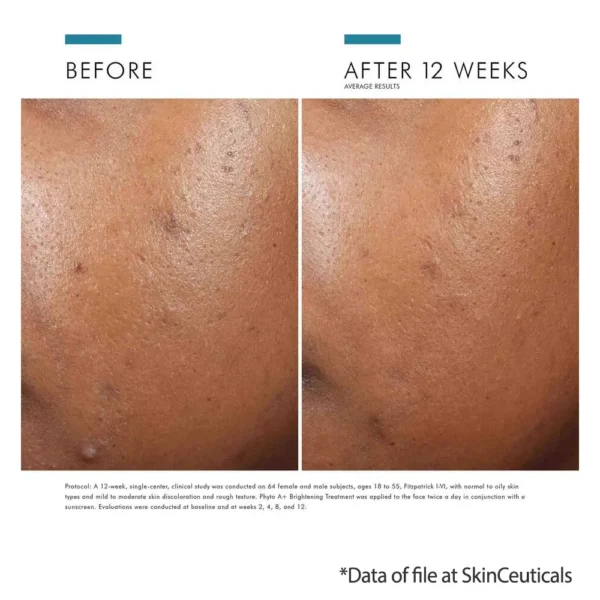 Skinceuticals Phyto A+ brightening treatment before and after results shows faded acne dark spots