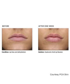 Plumper before and after lips with PCA HA Lip Booster