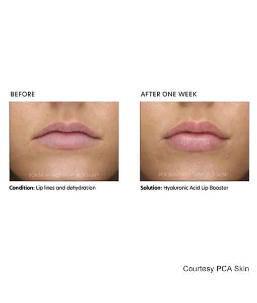 Plumper before and after lips with PCA HA Lip Booster
