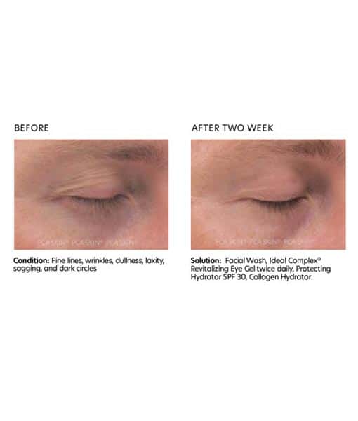 PCA Skin Ideal Complex Revitalizing Eye Gel before and after 1