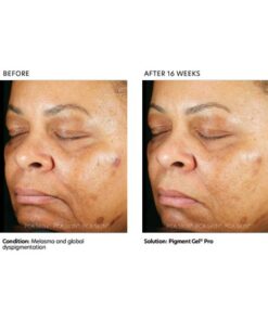PCA Skin Pigment Pro Gel before and after photos