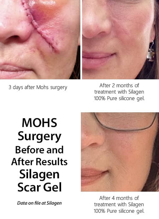 Before and after results of Silagen Scar Gel on face after surgery.