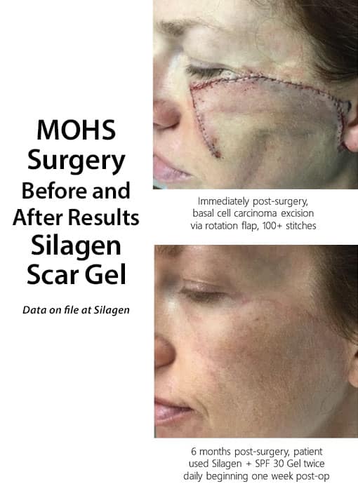 Before and after results of Silagen Scar Gel on woman's face after surgery.