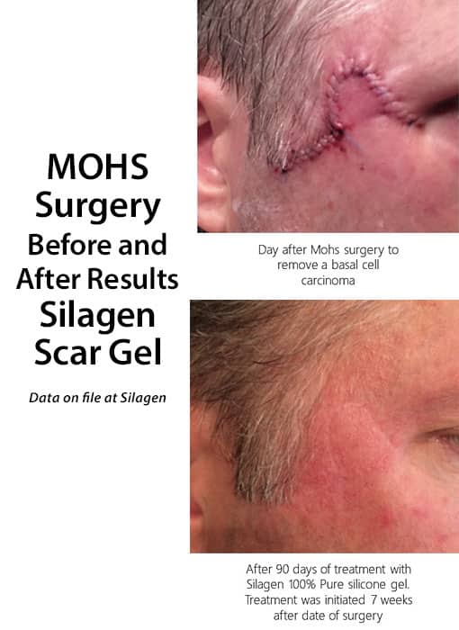Before and after results of Silagen Scar Gel on man's face after surgery.