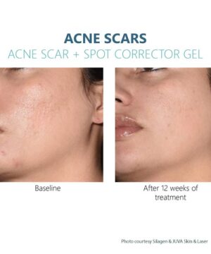 Silagen Acne Scars + Spot Corrector before and after photo