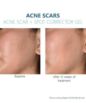Silagen Acne Scars + Spot Corrector results
