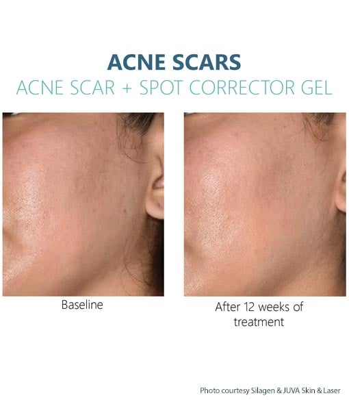 Silagen Acne Scars + Spot Corrector results