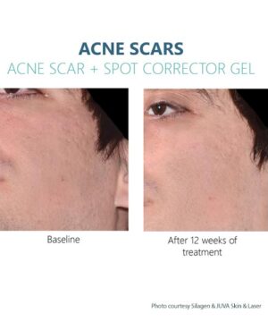 Male results with Silagen Acne Scars + Spot Corrector