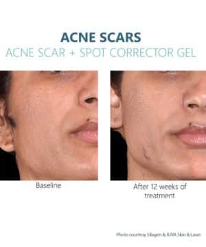 Wow results with Silagen Acne Scars + Spot Corrector