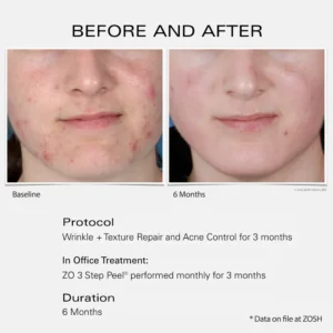 ZO Skin Health Acne Control before and after results