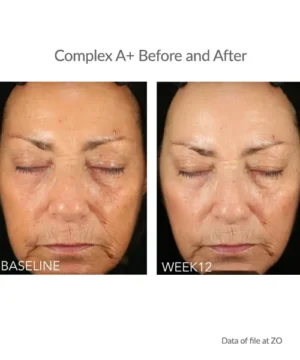 Before and after results after using ZO Complex A Retinol